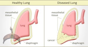 Mesothelioma Disease